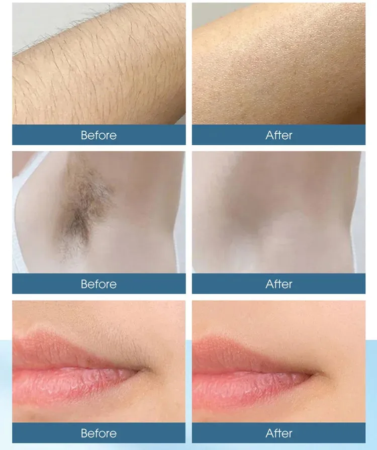 IPL Laser Hair Removal Device for Men and Women, Pain-free and Permanent Results, Safe for Whole Body Treatment